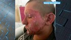 Una planta tóxica quemó la cara a este joven