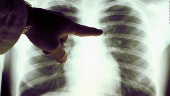 #SaludExpress: ¿Cómo ha evolucionado el cáncer de pulmón?