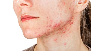 Los mitos y verdades del acné