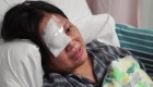 Periodista pierde la vista de un ojo por bala de goma