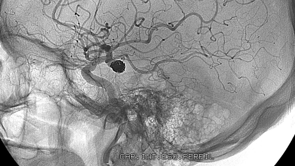 Aneurisma cerebral, una afección más común de lo que se cree